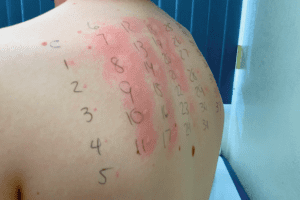 Food allergy testing